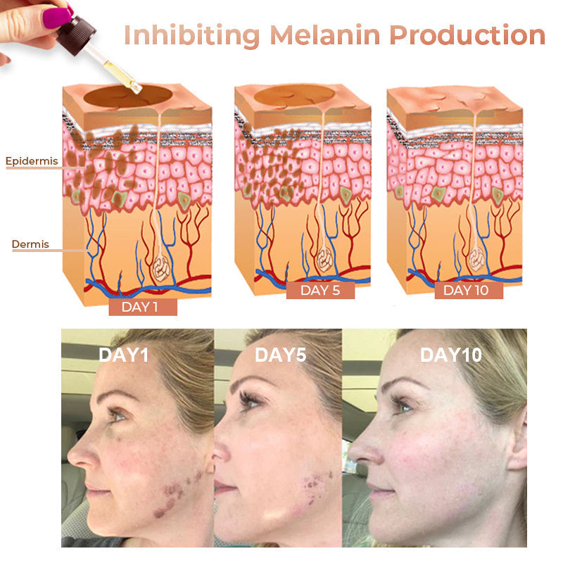 ✨Fast, Effective Dark Spot Treatment – NESLEMY™ Melanin Correcting Facial Serum