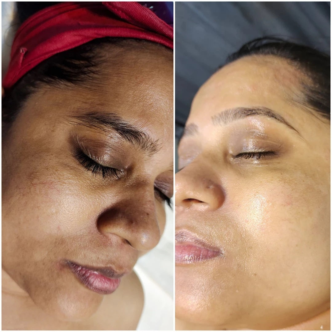 (🔥LAST DAY SALE-70% OFF)-Fast Dark Spot Remover-NESLEMY™ Turmeric Spot Repair Serum