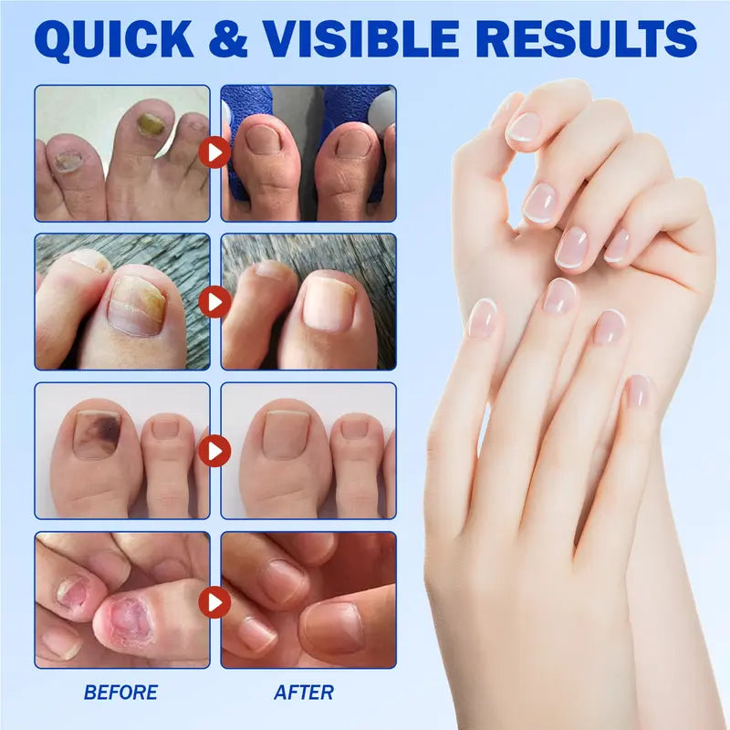 NESLEMY® Nail Fungus Care Patches