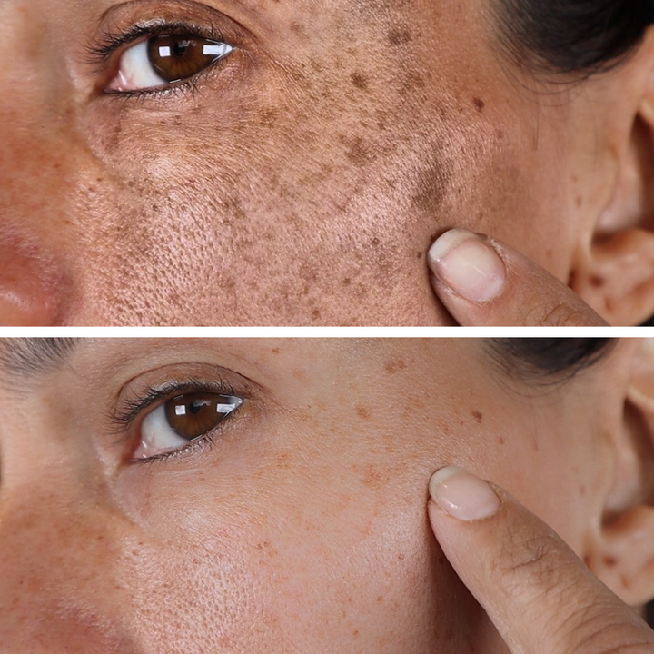 (🔥LAST DAY SALE-70% OFF)-Fast Dark Spot Remover-NESLEMY™ Turmeric Spot Repair Serum