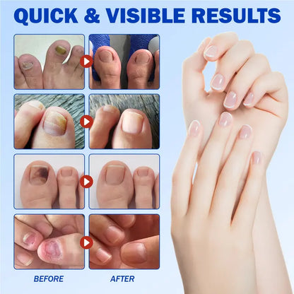 NESLEMY® Nail Fungus Care Patches
