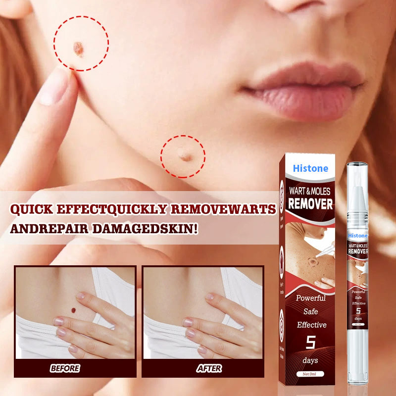 Histone™ Tags & Moles Remover