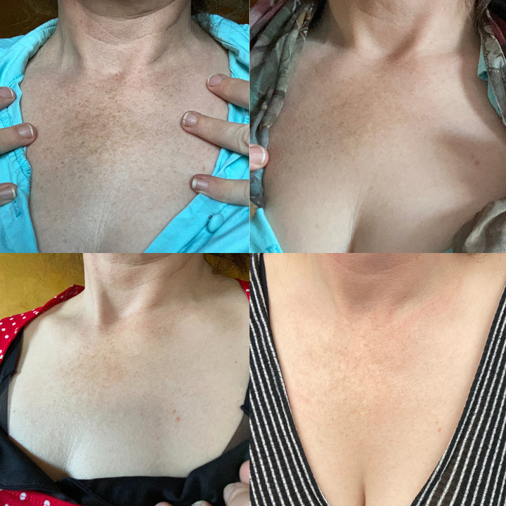 (🔥LAST DAY SALE-70% OFF)-Fast Dark Spot Remover-NESLEMY™ Turmeric Spot Repair Serum