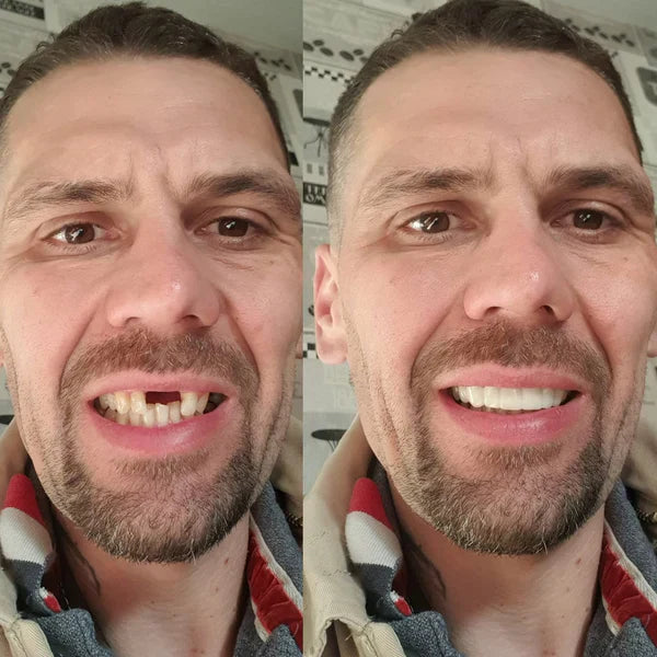 SmileFitPro® BioFusion Dentures🦷Suitable for all mouth shapes, perfect fit🦷