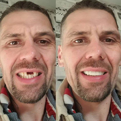 SmileFitPro® BioFusion Dentures🦷Suitable for all mouth shapes, perfect fit🦷