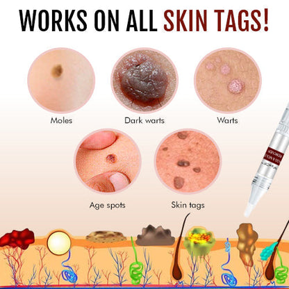 Lovilds™ Tags & Moles Remover 🔥 🔥🔥