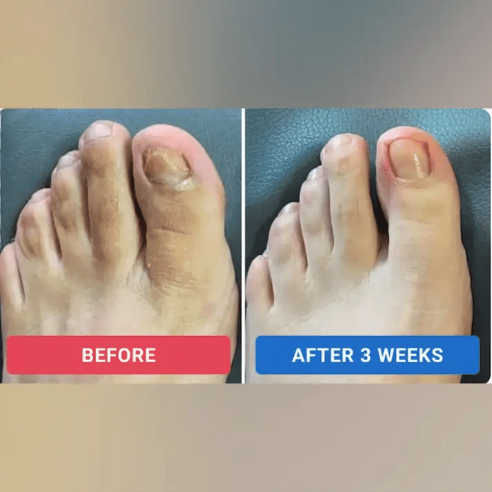 Slimoly®– Nail Repair Patches
