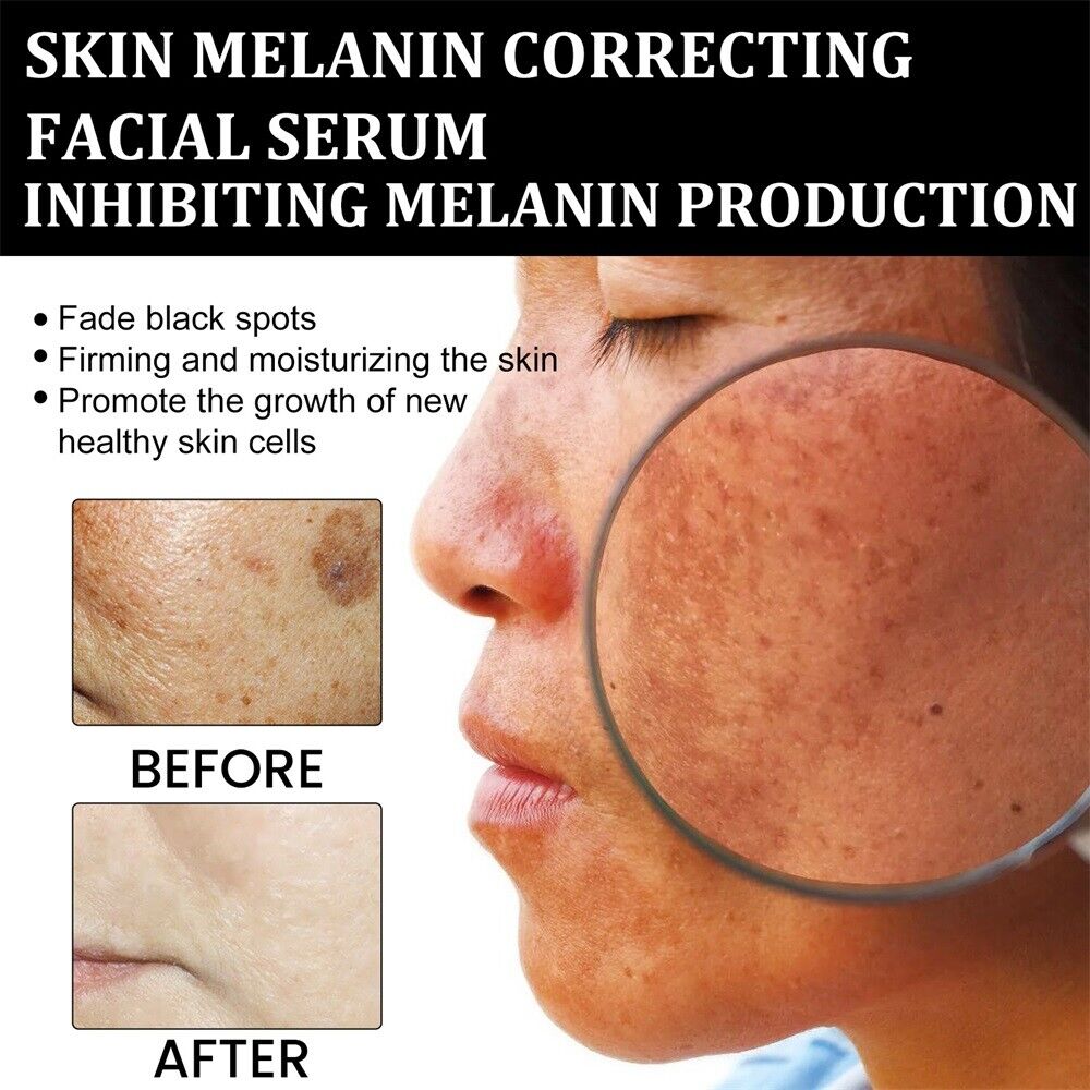 (🔥LAST DAY SALE-70% OFF)-Fast Dark Spot Remover-NESLEMY™ Turmeric Spot Repair Serum